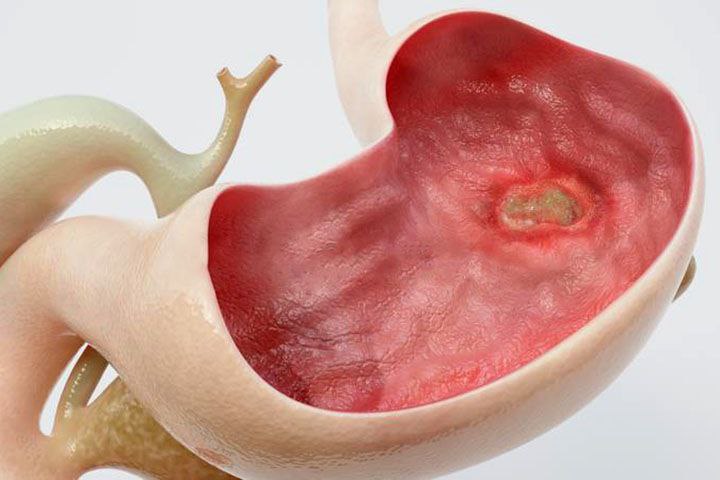 Ошқозон Яраси